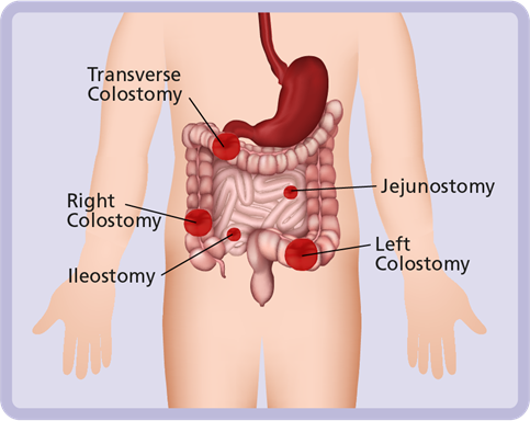 The Main Differences Between Ileostomy vs Colostomy Bag