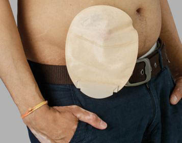 Man showing his stoma bag