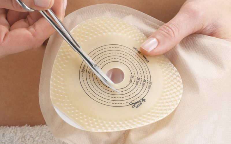 A cut to fit stoma