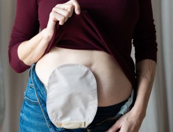 A woman lifting her top to show her stoma bag