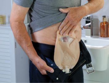 A man changing a stoma bag